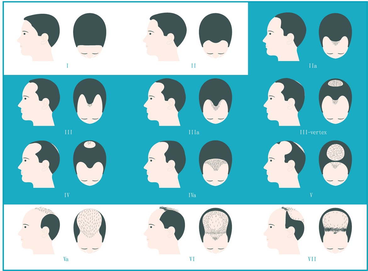 Male Pattern Baldness Treatment LLLT