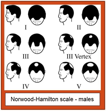 Norwood-Hamilton Scale